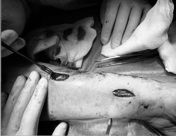 Майстер клас “Формування судинного доступу для гемодіалізу”